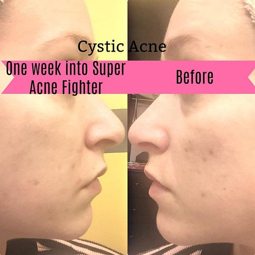 Super Acne Fighter / Organic Acne Treatment / Acne - Image 4